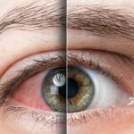 alcoholic eyes